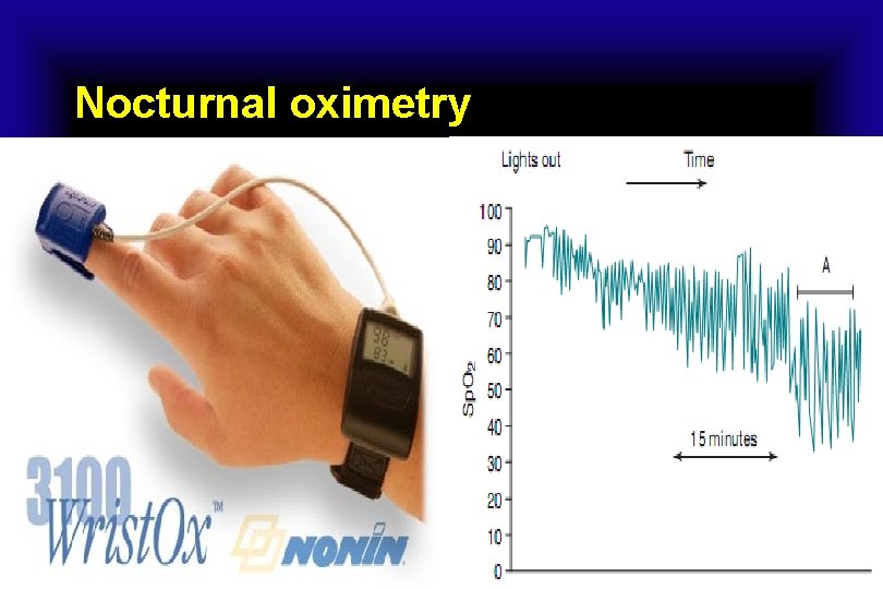 Nocturnal oximetry 