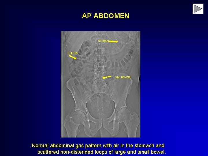 AP ABDOMEN STOMACH COLON SM. BOWEL Normal abdominal gas pattern with air in the