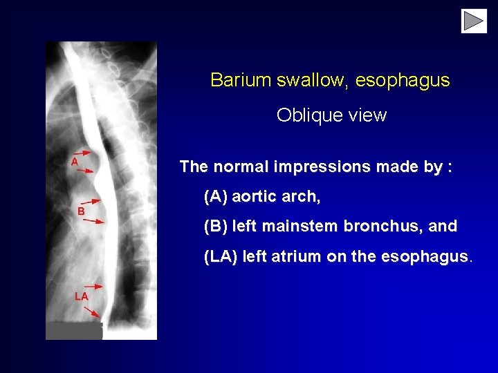 Barium swallow, esophagus. Oblique view The normal impressions made by : (A) aortic arch,