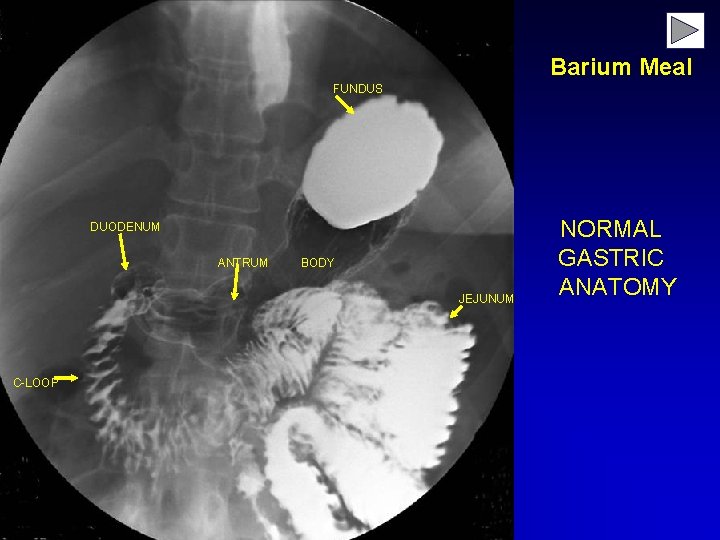 Barium Meal FUNDUS DUODENUM ANTRUM BODY JEJUNUM C-LOOP NORMAL GASTRIC ANATOMY 