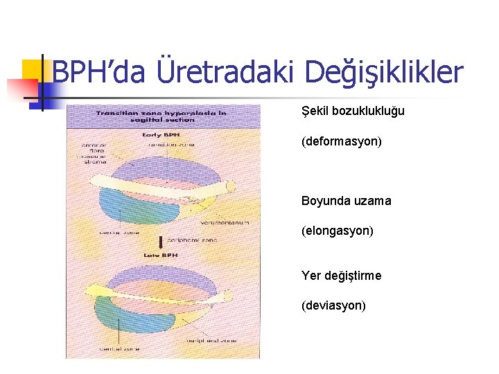 BPH’da Üretradaki Değişiklikler Şekil bozuklukluğu (deformasyon) Boyunda uzama (elongasyon) Yer değiştirme (deviasyon) 