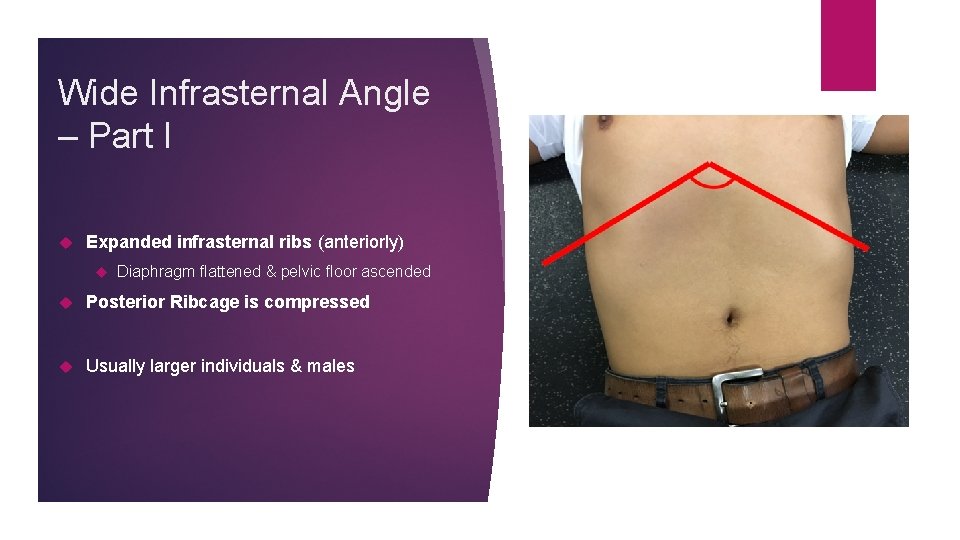 Wide Infrasternal Angle – Part I Expanded infrasternal ribs (anteriorly) Diaphragm flattened & pelvic