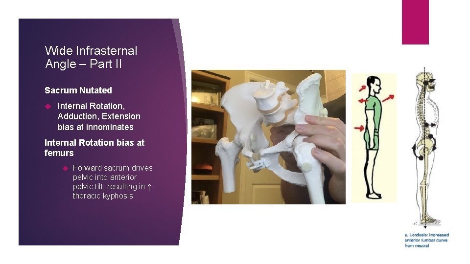 Wide Infrasternal Angle – Part II Sacrum Nutated Internal Rotation, Adduction, Extension bias at