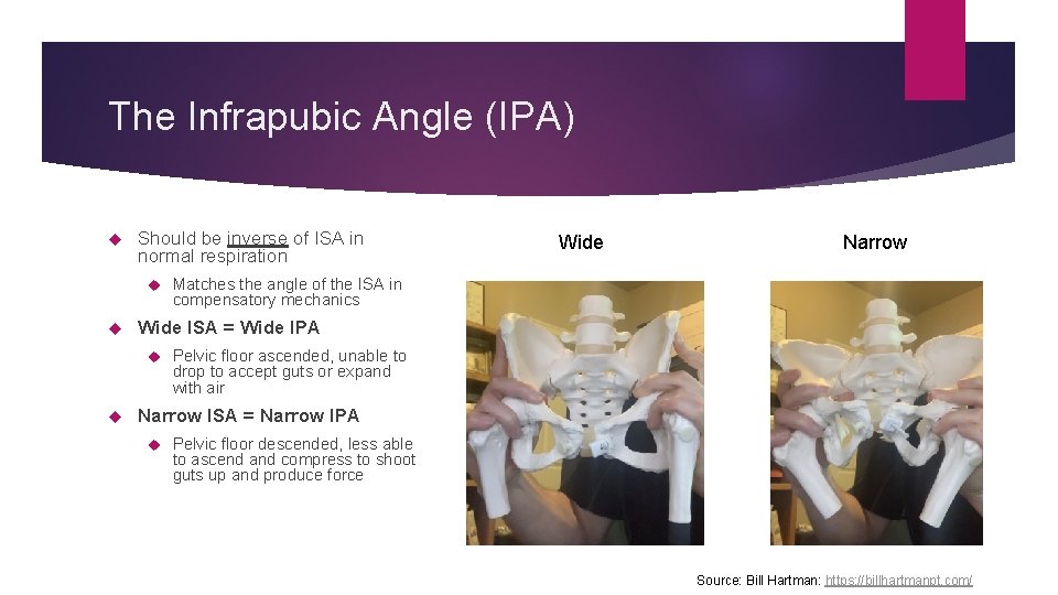 The Infrapubic Angle (IPA) Should be inverse of ISA in normal respiration Narrow Matches