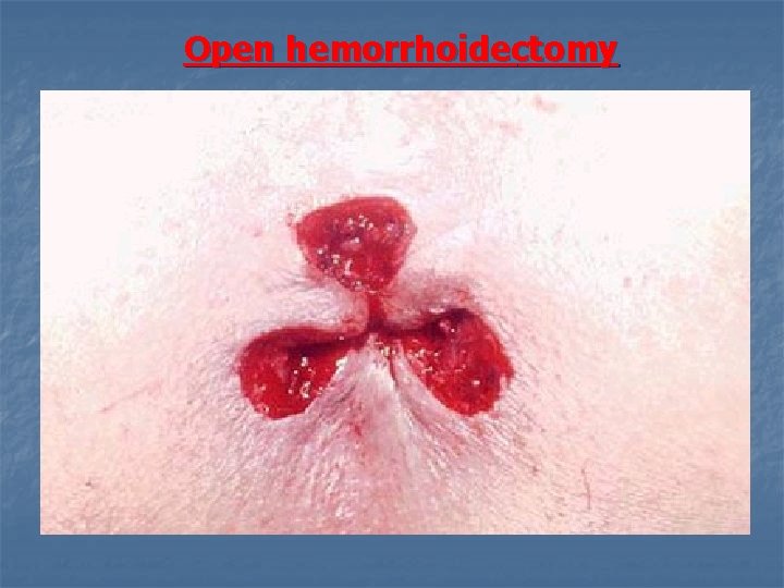 Open hemorrhoidectomy 