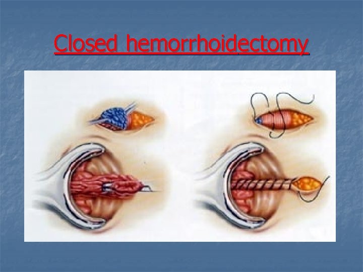 Closed hemorrhoidectomy 