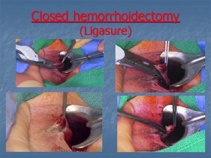 Closed hemorrhoidectomy (Ligasure) 