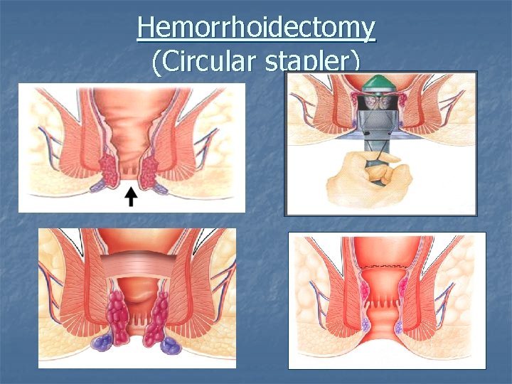 Hemorrhoidectomy (Circular stapler) 