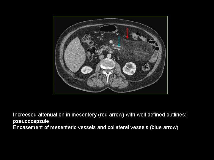 Increesed attenuation in mesentery (red arrow) with well defined outlines: pseudocapsule. Encasement of mesenteric