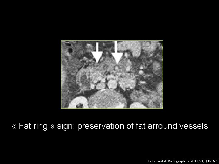  « Fat ring » sign: preservation of fat arround vessels Horton and al.