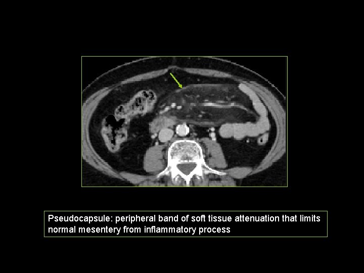 Pseudocapsule: peripheral band of soft tissue attenuation that limits normal mesentery from inflammatory process