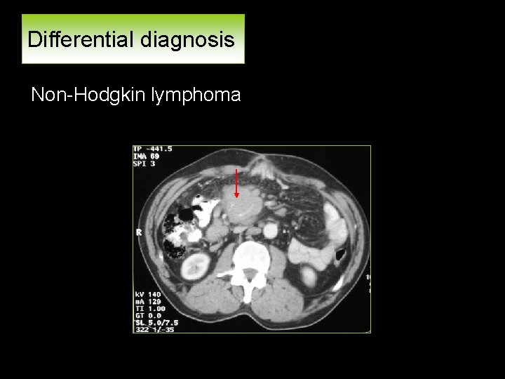 Differential diagnosis Non-Hodgkin lymphoma 