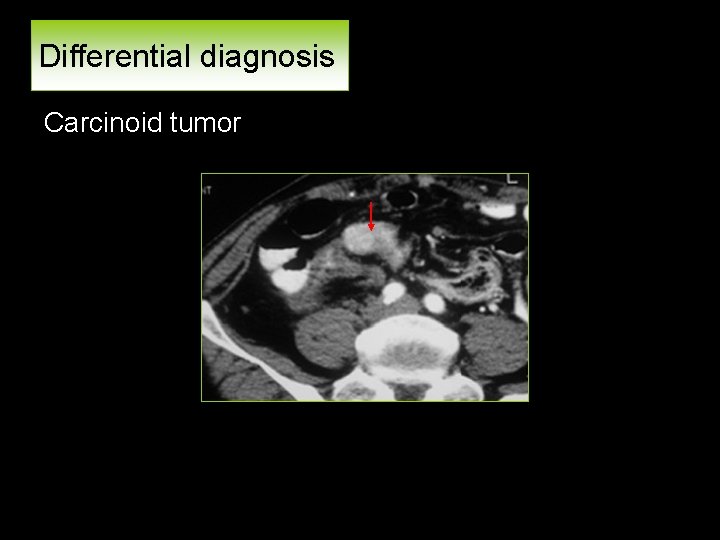Differential diagnosis Carcinoid tumor 
