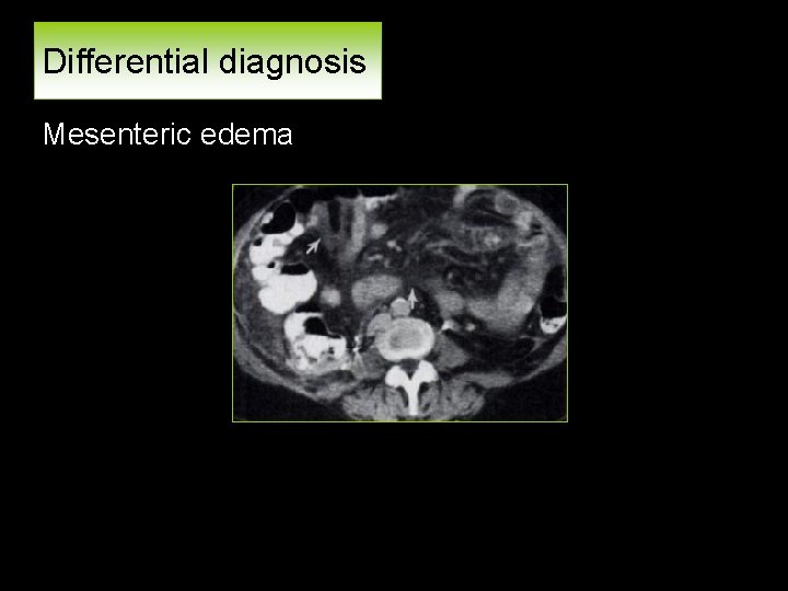 Differential diagnosis Mesenteric edema 