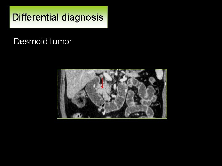 Differential diagnosis Desmoid tumor 