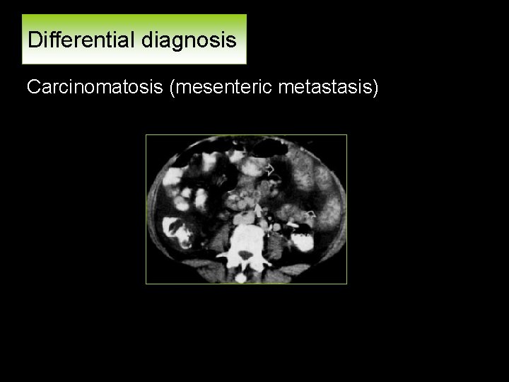 Differential diagnosis Carcinomatosis (mesenteric metastasis) 