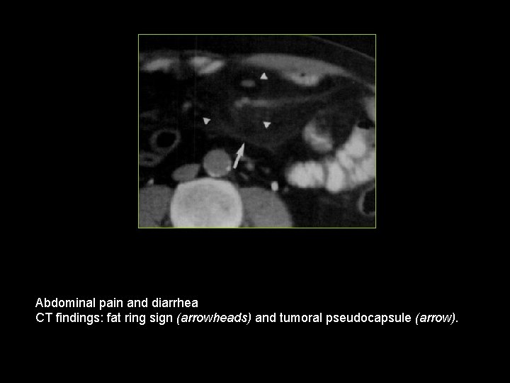 Abdominal pain and diarrhea CT findings: fat ring sign (arrowheads) and tumoral pseudocapsule (arrow).