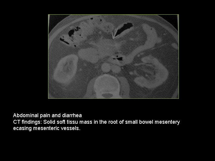 Abdominal pain and diarrhea CT findings: Solid soft tissu mass in the root of