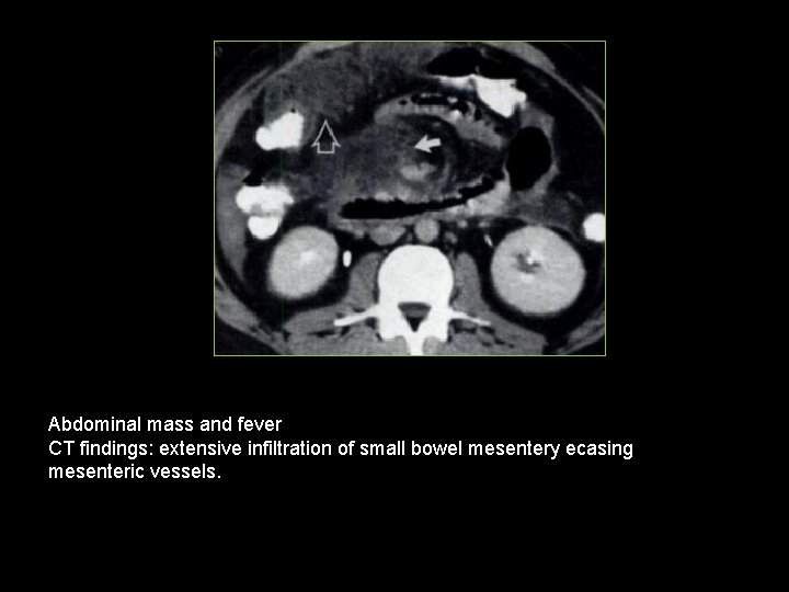 Abdominal mass and fever CT findings: extensive infiltration of small bowel mesentery ecasing mesenteric