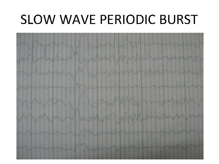 SLOW WAVE PERIODIC BURST 