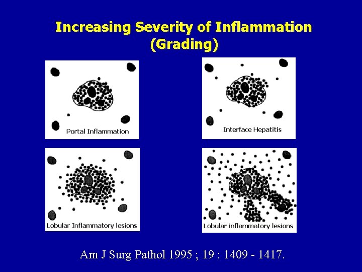 Increasing Severity of Inflammation (Grading) Am J Surg Pathol 1995 ; 19 : 1409