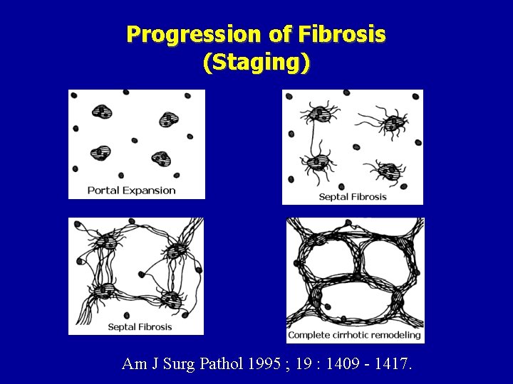 Progression of Fibrosis (Staging) Am J Surg Pathol 1995 ; 19 : 1409 -