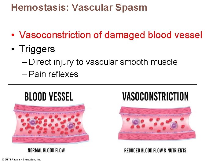 Hemostasis: Vascular Spasm • Vasoconstriction of damaged blood vessel • Triggers – Direct injury