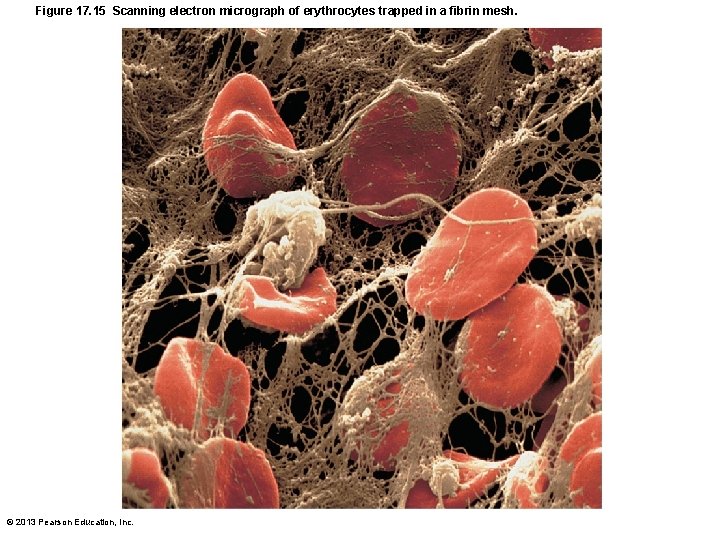 Figure 17. 15 Scanning electron micrograph of erythrocytes trapped in a fibrin mesh. ©