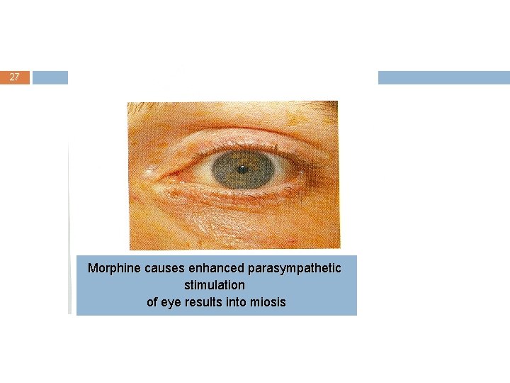 27 Morphine causes enhanced parasympathetic stimulation of eye results into miosis 
