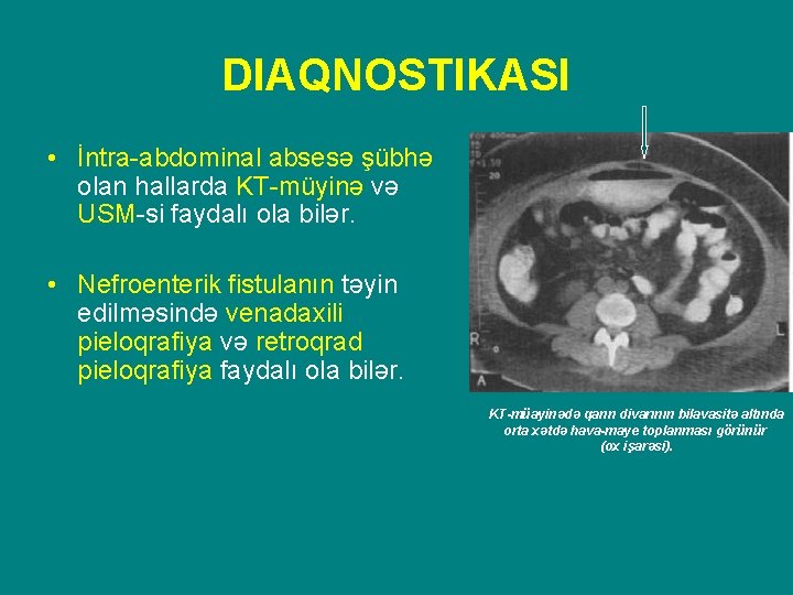 DIAQNOSTIKASI • İntra-abdominal absesə şübhə olan hallarda KT-müyinə və USM-si faydalı ola bilər. •