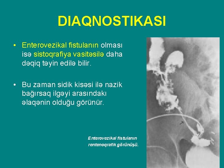 DIAQNOSTIKASI • Enterovezikal fistulanın olması isə sistoqrafiya vasitəsilə daha dəqiq təyin edilə bilir. •