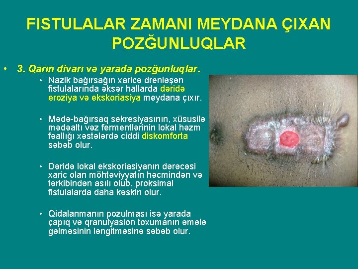 FISTULALAR ZAMANI MEYDANA ÇIXAN POZĞUNLUQLAR • 3. Qarın divarı və yarada pozğunluqlar. • Nazik