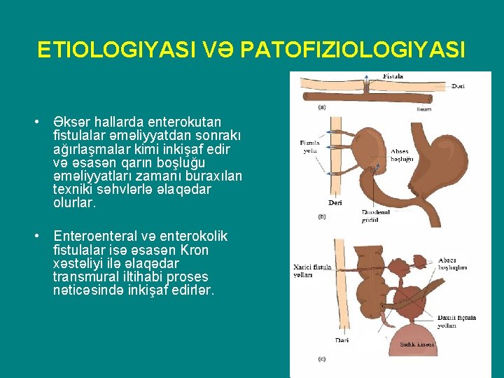 ETIOLOGIYASI VƏ PATOFIZIOLOGIYASI • Əksər hallarda enterokutan fistulalar əməliyyatdan sonrakı ağırlaşmalar kimi inkişaf edir