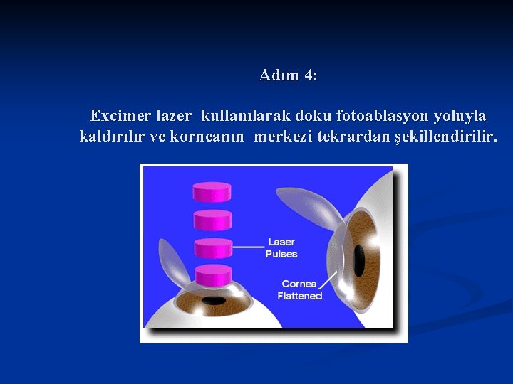 Adım 4: Excimer lazer kullanılarak doku fotoablasyon yoluyla kaldırılır ve korneanın merkezi tekrardan şekillendirilir.