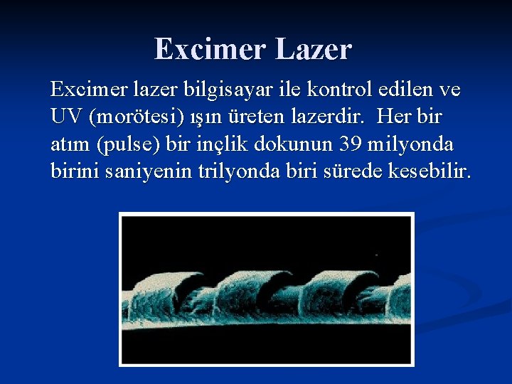 Excimer Lazer Excimer lazer bilgisayar ile kontrol edilen ve UV (morötesi) ışın üreten lazerdir.