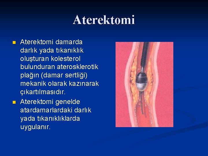 Aterektomi n n Aterektomi damarda darlık yada tıkanıklık oluşturan kolesterol bulunduran aterosklerotik plağın (damar