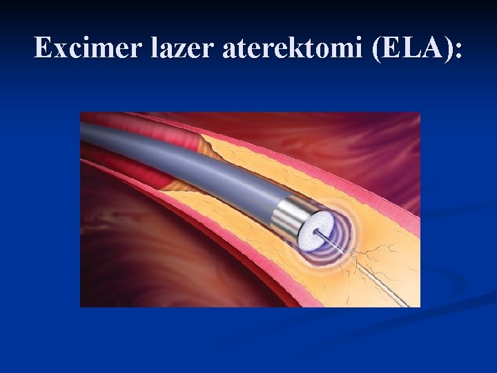 Excimer lazer aterektomi (ELA): 