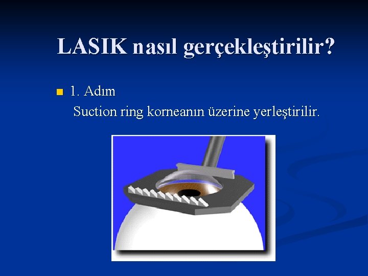 LASIK nasıl gerçekleştirilir? n 1. Adım Suction ring korneanın üzerine yerleştirilir. 