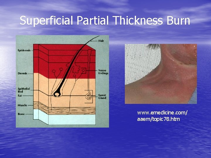 Superficial Partial Thickness Burn www. emedicine. com/ aaem/topic 78. htm 