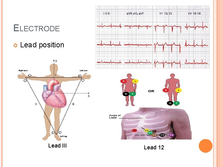 ELECTRODE Lead position Lead III Lead 12 