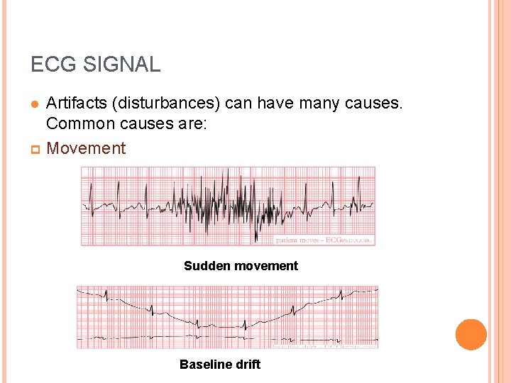 ECG SIGNAL Artifacts (disturbances) can have many causes. Common causes are: p Movement l