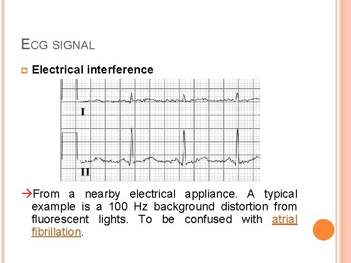 ECG SIGNAL p Electrical interference From a nearby electrical appliance. A typical example is