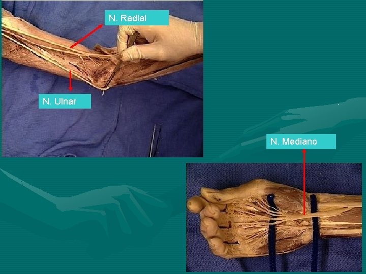 N. Radial N. Ulnar N. Mediano 