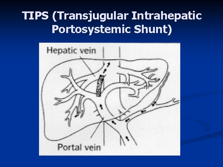 TIPS (Transjugular Intrahepatic Portosystemic Shunt) 