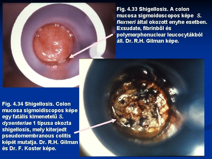 Fig. 4. 33 Shigellosis. A colon mucosa sigmoidoscopos képe S. flexneri által okozott enyhe
