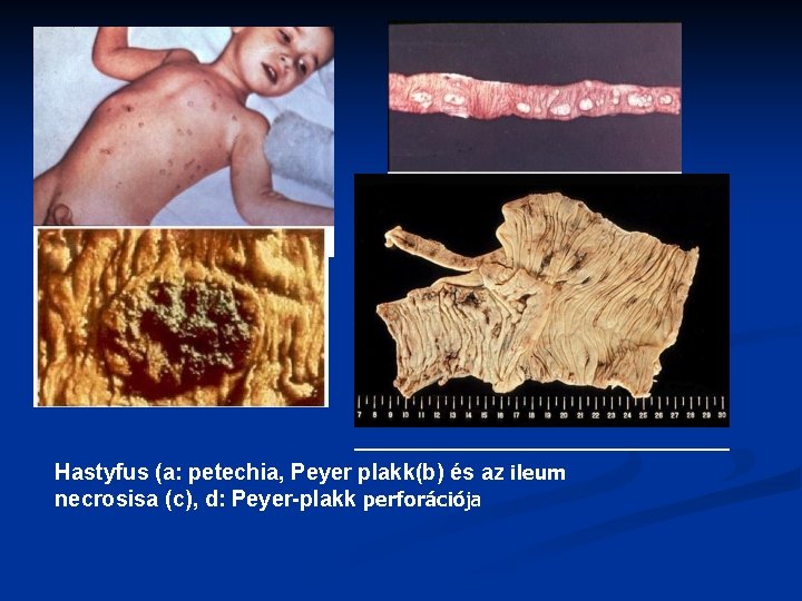 Hastyfus (a: petechia, Peyer plakk(b) és az ileum necrosisa (c), d: Peyer-plakk perforációja 