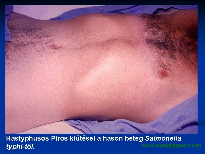 Hastyphusos Piros kiütései a hason beteg Salmonella www. wrongdiagnosis. com typhi-től. 