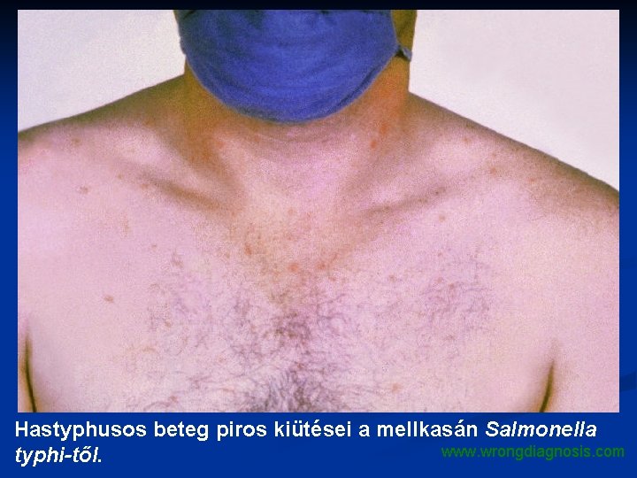 Hastyphusos beteg piros kiütései a mellkasán Salmonella www. wrongdiagnosis. com typhi-től. 