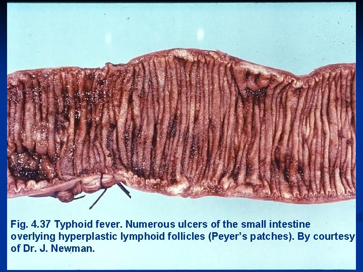 Fig. 4. 37 Typhoid fever. Numerous ulcers of the small intestine overlying hyperplastic lymphoid