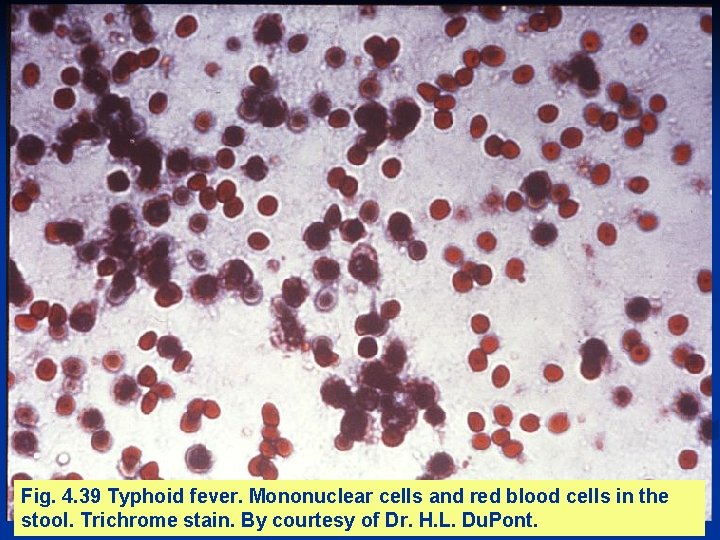 Fig. 4. 39 Typhoid fever. Mononuclear cells and red blood cells in the stool.